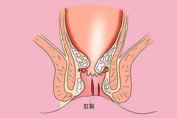 肛裂一个月未愈合，原因、治疗与预防